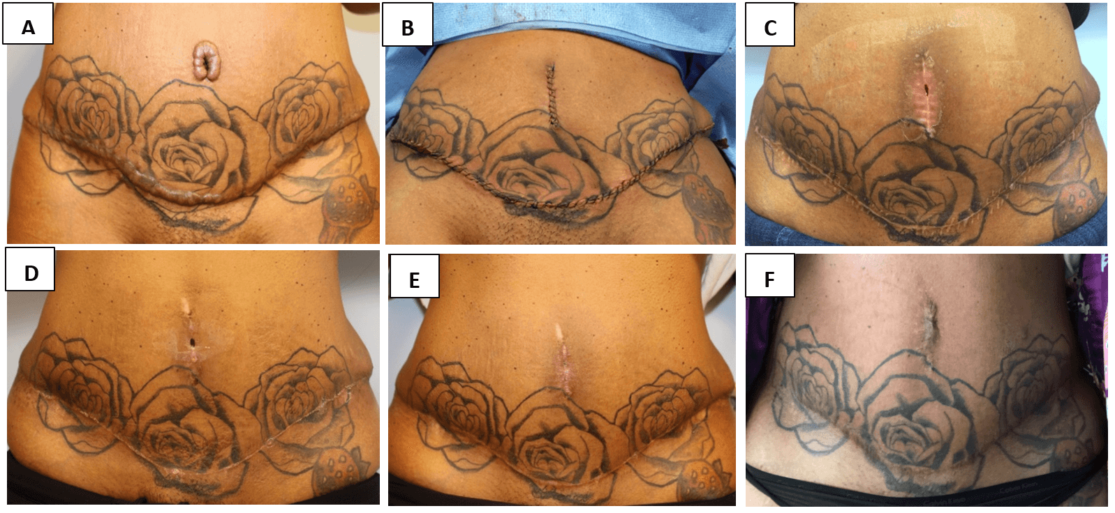 Keloids of the Lower Abdomen, Mons and Vulva: Several Case Studies  Highlighting a Successful Approach to Treatment | Radiotherapy and Clinical  Oncology | Science Repository | Open Access