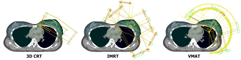 Most Appropriate Radiation Therapy Techniques For The Breast Cancer Most Appropriate Radiation Therapy Techniques For The Breast Cancer