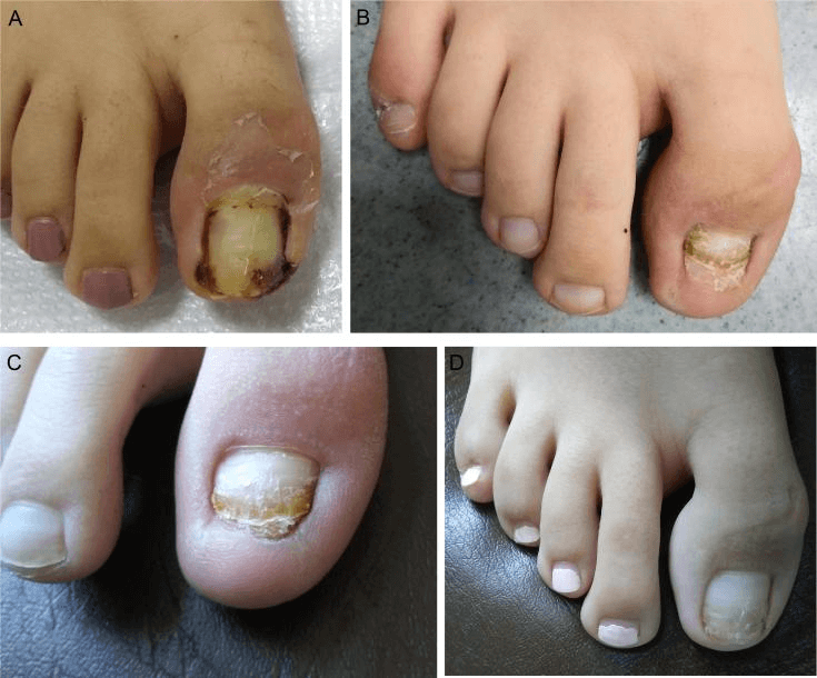 Retronychia Treated with Proximal Nail Avulsion; two Cases Successfully  Treated with this Technique and the First cases of Retronychia Occurring  After Chemical Matricectomy