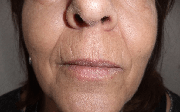 Lines and Wrinkles on the Upper Lip and Around the Mouth Explained – Caci