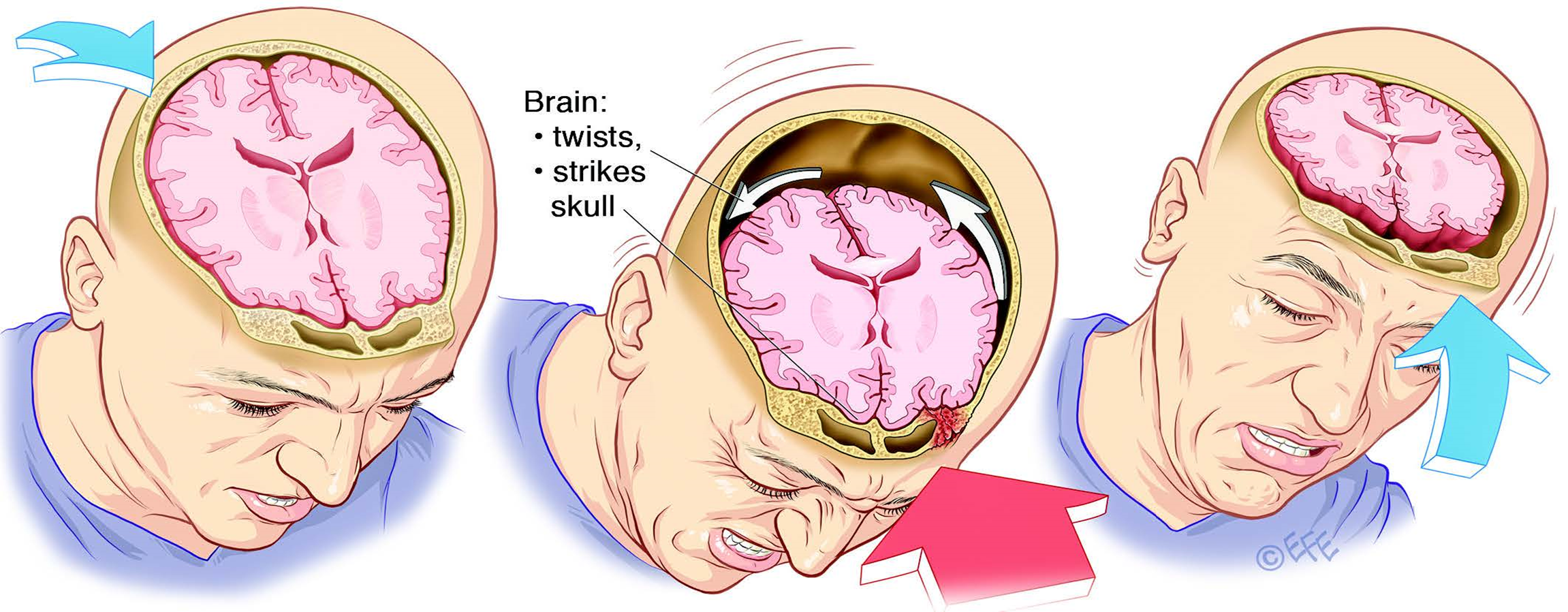 Сколько длится сотрясение. Сотрясение головного мозга. Закрытая травма черепа и головного мозга. ЧМТ сотрясение головного мозга.